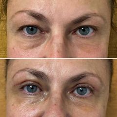 Korekta powiek górnych - dr n. med. Karolina Wójcicka