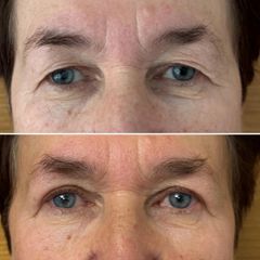 Korekta powiek górnych - dr n. med. Karolina Wójcicka