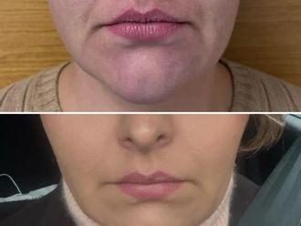 Nici liftingujące przed i po - 877192