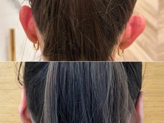 Korekcja uszu przed i po - 877193