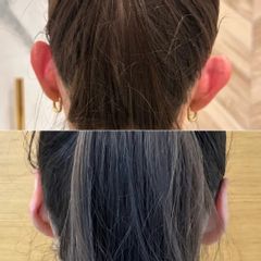 Stan po korekcie odstających małżowin usznych