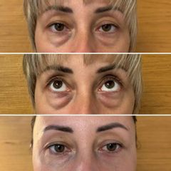 Korekta powiek dolnych dr n. med. Karolina Wójcicka