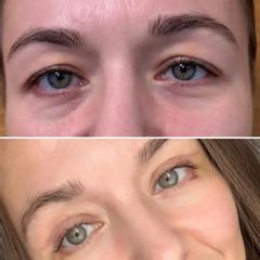 Korekta powiek górnych