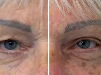 Blefaroplastyka przed i po - 879460