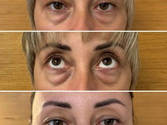 Blefaroplastyka przed i po - 879462