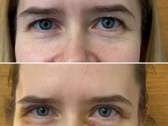 Blefaroplastyka przed i po - 879463