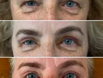 Blefaroplastyka przed i po - 880987