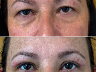 Blefaroplastyka przed i po - 880988
