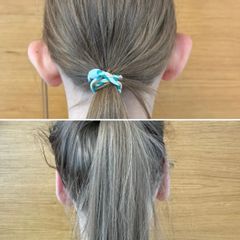 Korekta odstających małżowin usznych - dr n. med. Karolina Wójcicka