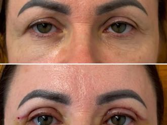 Blefaroplastyka przed i po - 881029