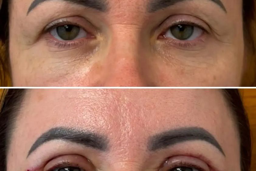 Blefaroplastyka przed i po - 881029