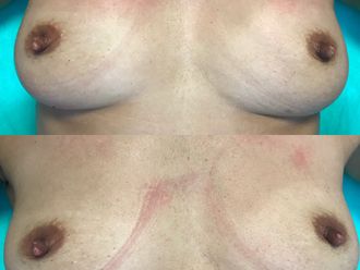 Mezoterapia igłowa przed i po - 821751