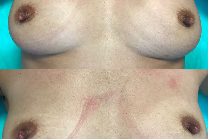Mezoterapia igłowa przed i po - 821751