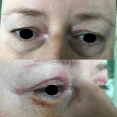 Blefaroplastyka - dr Rafał Woś