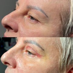 blefaroplastyka - dr Rafał Woś