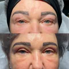 Blefaroplastyka  -dr Rafał Woś