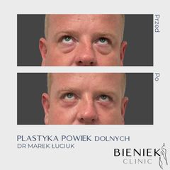 Blefaroplastyka - Dr n. med. Marek Łuciuk