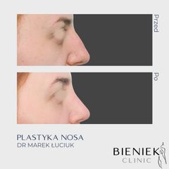 Korekta nosa - Dr n. med. Marek Łuciuk