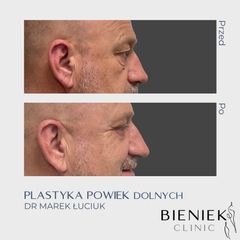 Blefaroplastyka - Dr n. med. Marek Łuciuk