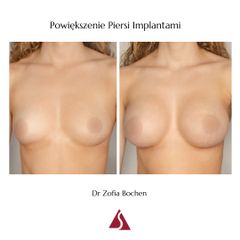 Powiększanie biustu - Klinika Dr Szczyt