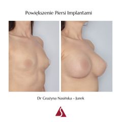 Powiększanie biustu - Klinika Dr Szczyt