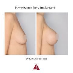Powiększanie biustu - Klinika Dr Szczyt