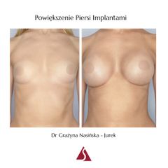 Powiększanie biustu - Klinika Dr Szczyt