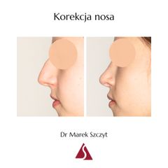 Korekta nosa - Klinika Dr Szczyt