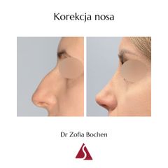 Korekta nosa - Klinika Dr Szczyt