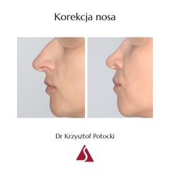 Korekta nosa - Klinika Dr Szczyt