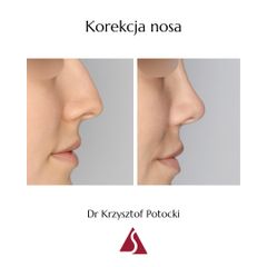 Korekta nosa - Klinika Dr Szczyt