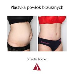 Plastyka brzucha - Klinika Dr Szczyt
