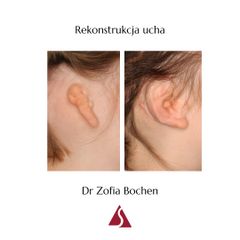 Rekonstrukcja ucha - Klinika Dr Szczyt