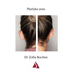 Korekcja uszu - Klinika Dr Szczyt