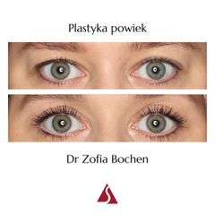 Blefaroplastyka - Klinika Dr Szczyt