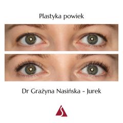 Blefaroplastyka - Klinika Dr Szczyt