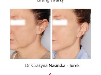 Lifting twarzy przed i po - 860713