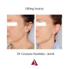 Lifting twarzy - Klinika Dr Szczyt