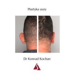 Korekcja uszu - Klinika Dr Szczyt