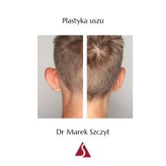 Korekcja uszu - Klinika Dr Szczyt