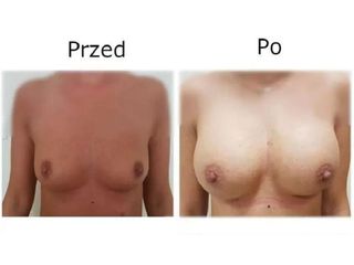 Przed i po - powiększanie biustu