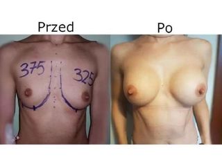 Przed i po - powiększanie piersi