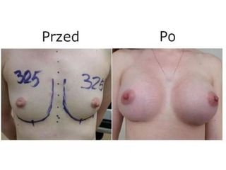 Przed i po - powiększanie biustu