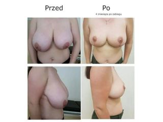 Przed i po - mastopeksja
