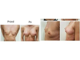 Przed i po - powiększanie biustu