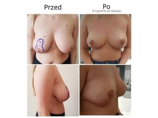 Przed i po - lifting biustu