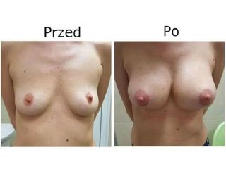 Przed i po - powiększanie biustu