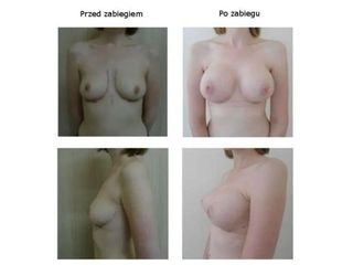 Przed i po - powiększanie biustu