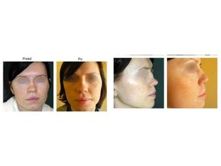 Przed i po - rhinoplastyka