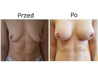 Przed i po - powiększanie piersi